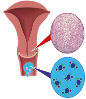 A HPV-fertőzés tünetei nőkben és férfiakban - Medicover - Ár papillómák